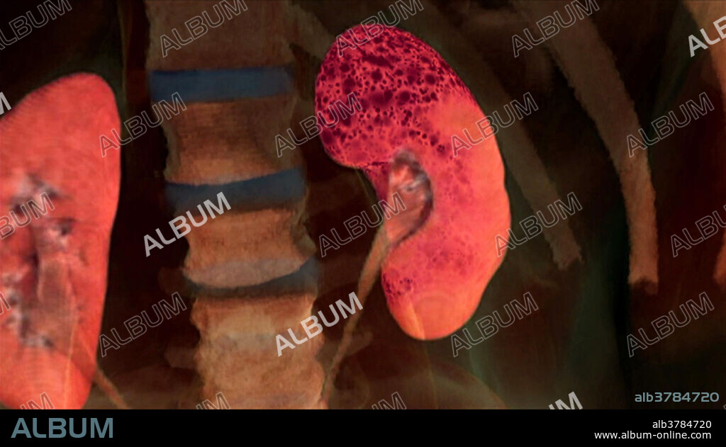 CT data showing kidney failure (dark spots, left kidney).