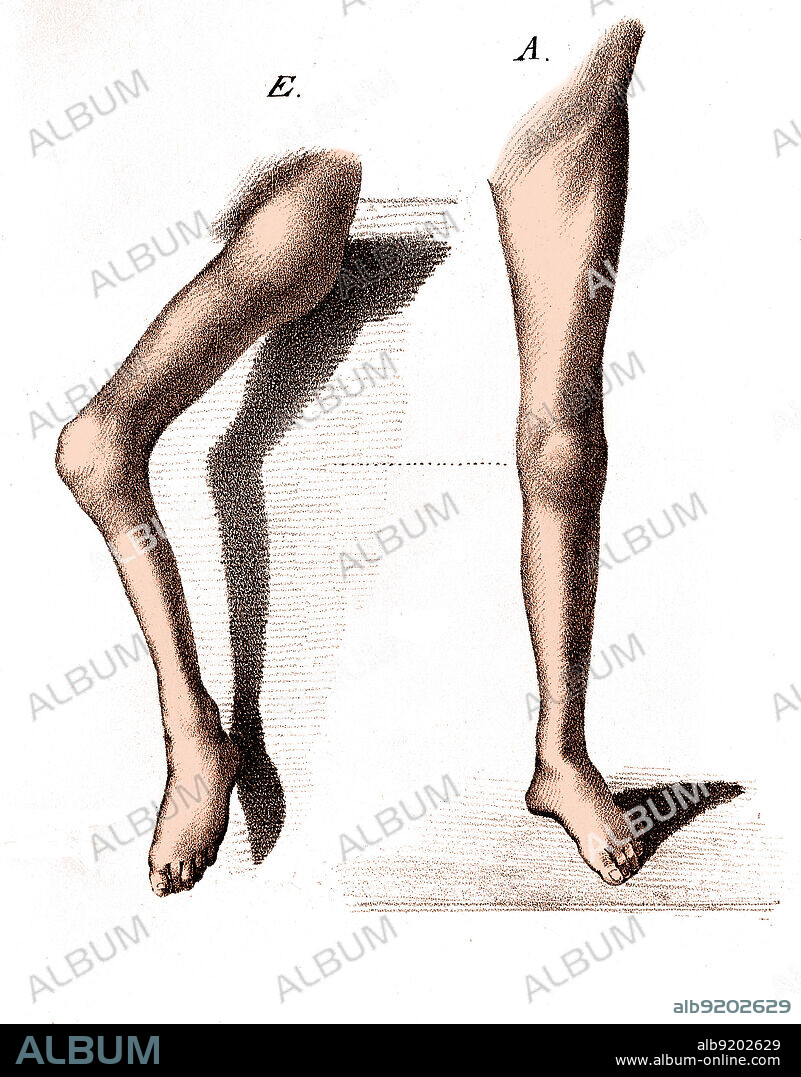 Polio Paralysis, Heine, 1840