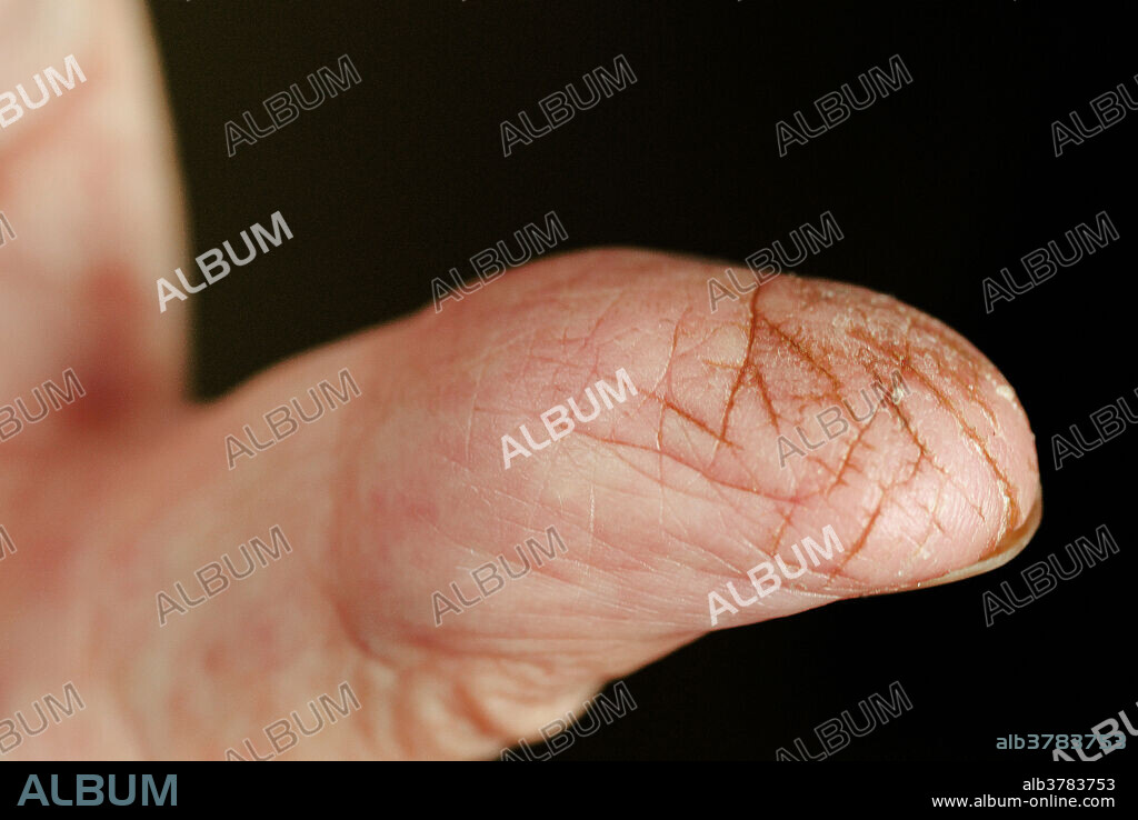 Painful cracks developed in the skin of the thumb of a senior (80+) male. They healed after a treatment with a hand lotion containing Aloe vera.