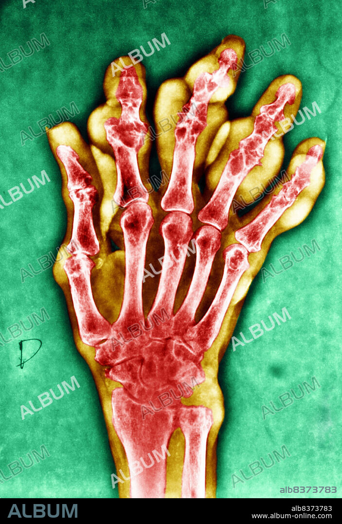 GOUT, X-RAY.