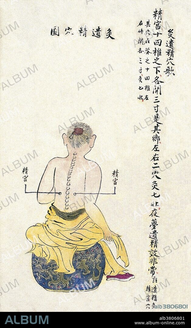 Acu-moxa point chart, showing the jinggong (Palace of Essence/Semen) point, from Chuanwu lingji lu (Record of Sovereign Teachings), by Zhang Youheng, a treatise on acu-moxa in two volumes. This work survives only in a manuscript draft, completed in 1869 (8th year of the Tongzhi reign period of the Qing dynasty). The text states: The jinggong point is located below the 14th vertebra, 3 cun to either side of it. Moxibusted with 7 moxa cones, it can be used to treat nocturnal emission.