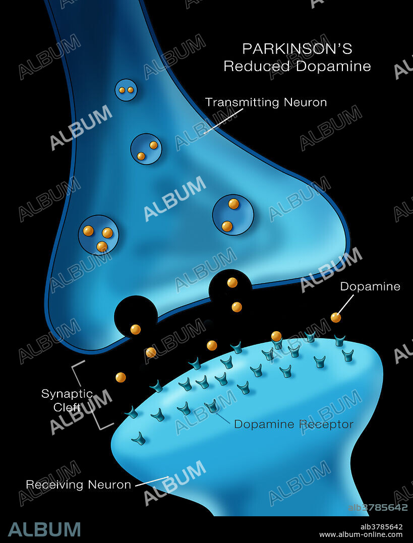 Labelled illustration showing low levels of the neurotransmitter dopamine in a neuron affected by Parkinson's disease.