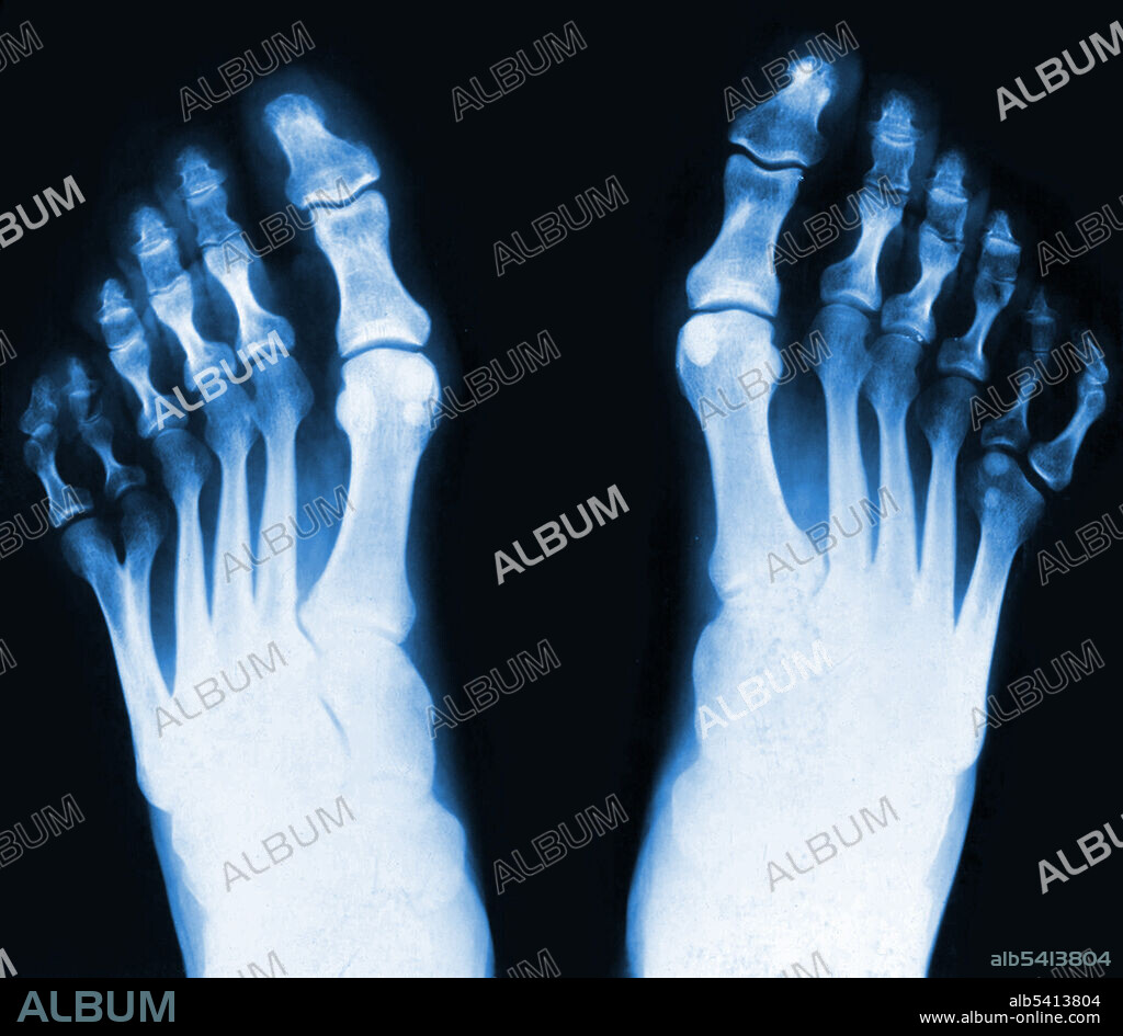 X-ray of feet, showing postaxial polydactyly. Polydactylism is the congenital abnormality of having extraneous fingers or toes. As visible above, this individual had six toes on both feet. This is an example of postaxial polydactyly, because the extra digit occurs on the pinky side of the foot.