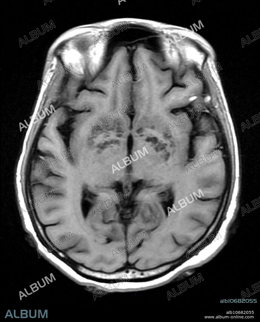 This axial (cross sectional) T1-weighted MR image of the brain demonstrates multiple cystic spaces in the basal ganglia regions which did not enhance with contrast. These represent gelatinous pseudocysts seen in AIDS patients with cryptococcal meningitis.