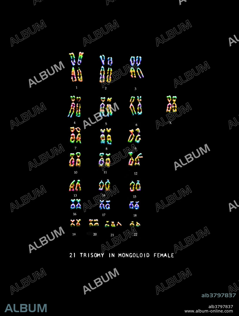 Colour enhanced micrograph of a karyotype for a human female with Down's Syndrome. It is characterized by an extra copy of genetic material on the 21st chromosome. Karyotypes are an arrangement of chromosomes based on their appearance under a light microscope. (Enhancement of 9C3488).