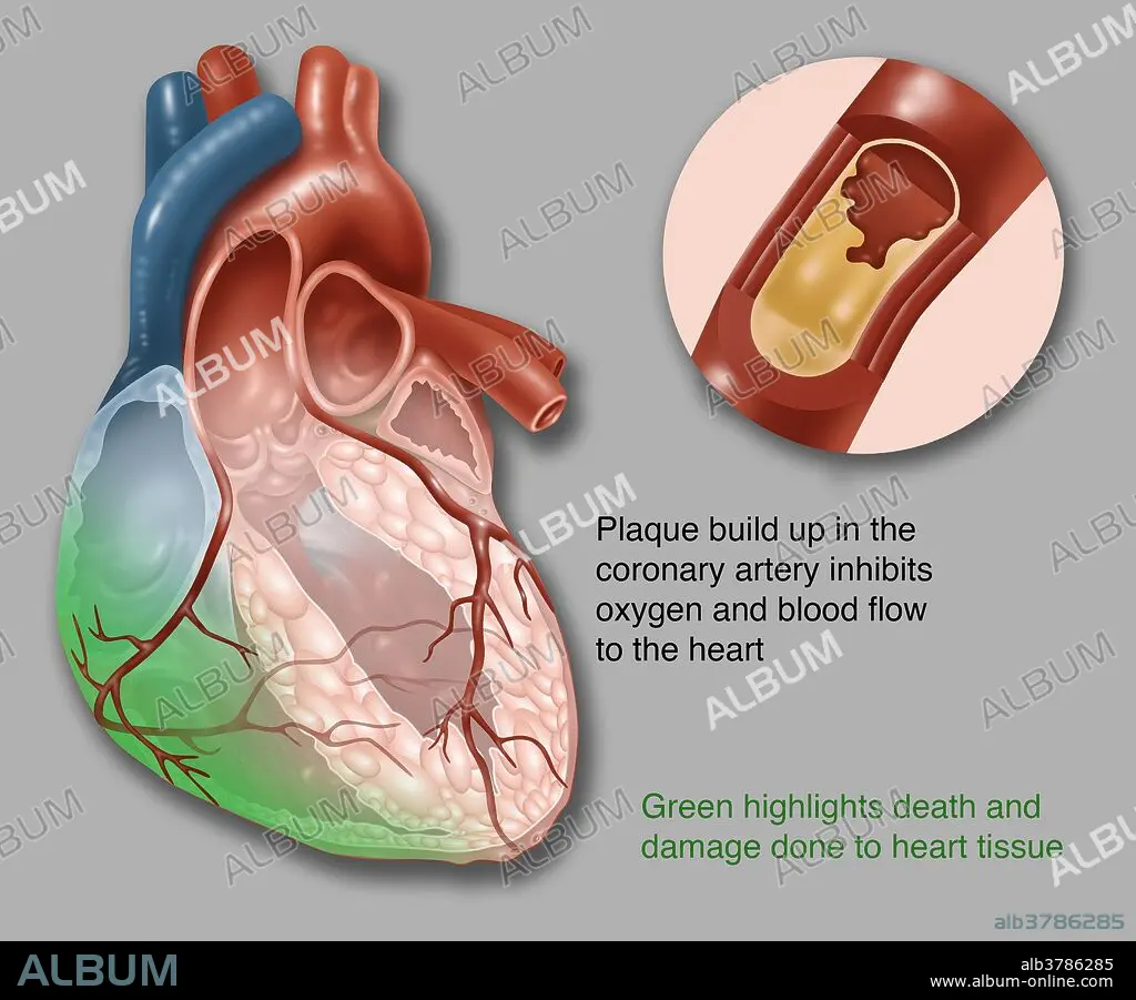 llustration showing acute heart failure. Plaque build-up in the