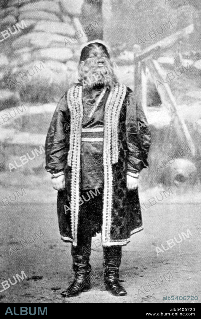 Fedor Jeftichew AKA Jo-Jo the Dog-Faced Boy (1868 - January 31, 1904) was a Russian sideshow performer afflicted with hypertrichosis. He was 5' 8" tall, had only four or five teeth, spoke Russian, German, a little English, and dressed like a Russian cavalryman. In 1884, he signed with P. T. Barnum. Barnum advertised him as 'the most prodigious paragon of all prodigies secured by P. T. Barnum in fifty years. The Human Skye Terrier, the crowning mystery of nature's contradictions.' He toured Europe with Barnum and Bailey's Greatest Show on Earth in 1901 and 1902. He died in Greece in 1904 while on tour of pneumonia. The Wonder Book of Freaks and Animals in the Barnum & Bailey Greatest Show on Earth, 1898.