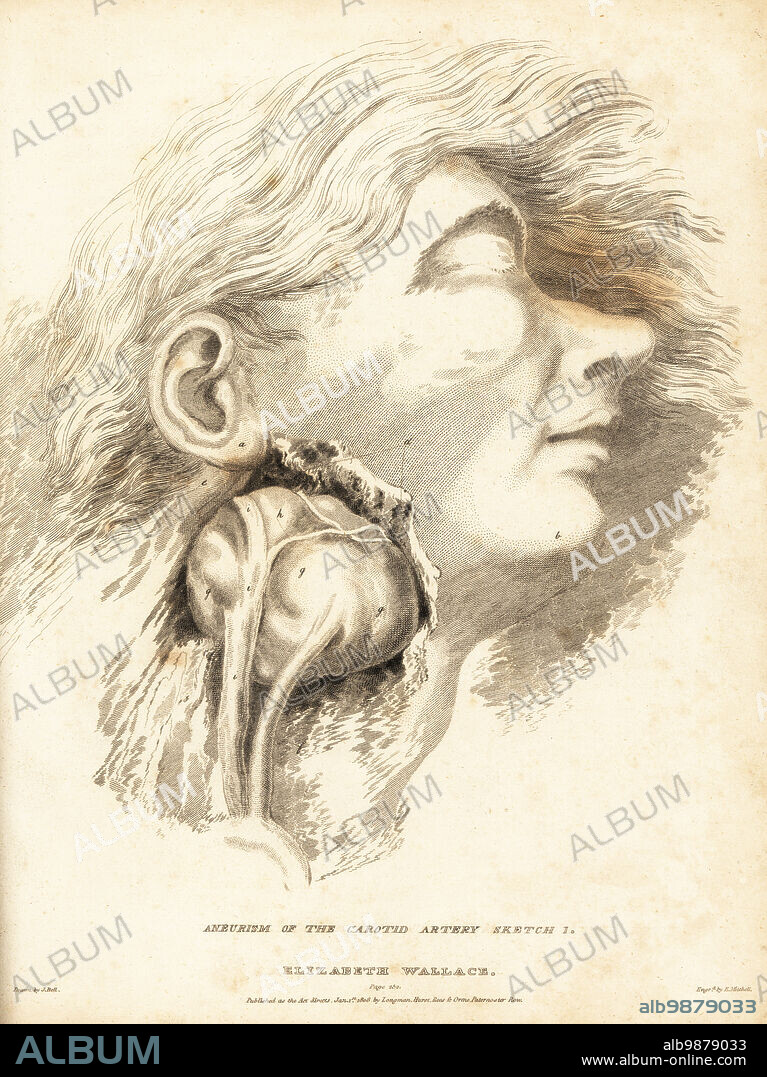 Dissection of a fatal tumor in the neck of a young woman. The fast-growing cancer suffocated her in a month. Elizabeth Wallace, 24-year-old woman "flesh cadie," a meat porter in a butcher market. Aneurism of the carotid artery, Sketch 1. Copperplate engraving by Edward Mitchell after an illustration by John Bell from his own Principles of Surgery, as they Relate to Wounds, Ulcers and Fistulas, Longman, Hurst, Rees, Orme and Brown, London, 1815.