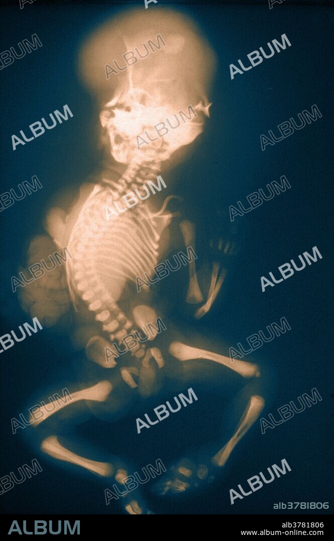 Color enhanced X-ray of extremely deformed human fetus.