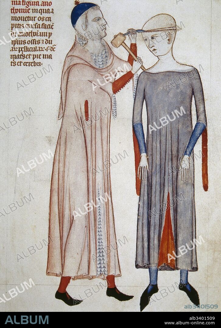 Epoca Medieval. Cirujano médico realizando una trepanación. Siglo XV. Anatomia de Guy de Pavia, 1345. Artista anónimo. Museo Condé. Castillo de Chantilly. Francia.