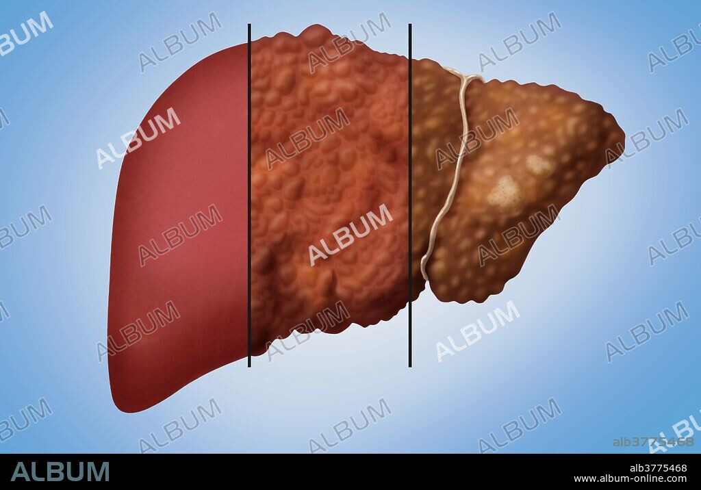 Illustration comparing the appearance a healthy liver (left) with its appearance in cirrhosis and hepatocellular carcinoma, or liver cancer. Cirrhosis is a consequence of chronic liver disease characterized by replacement of liver tissue with fibrosis, scar tissue and regenerative nodules (lumps that occur as a result of a process in which damaged tissue is regenerated), leading to loss of liver function. Liver cancer is often secondary to cirrhosis. Hepatitis C can lead to cirrhosis and/or liver cancer; with alcohol abuse being another major risk factor.