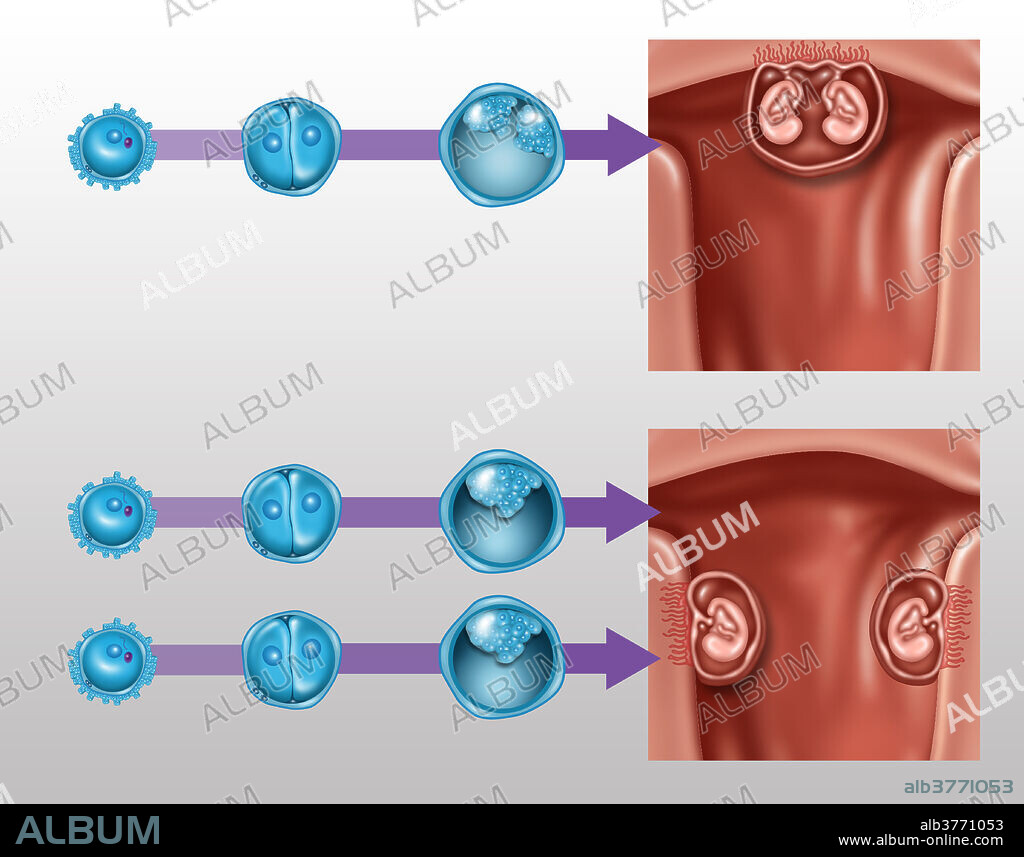 Illustration of the development of Identical (Monozygotic) and fraternal (Dizygotic) twins.