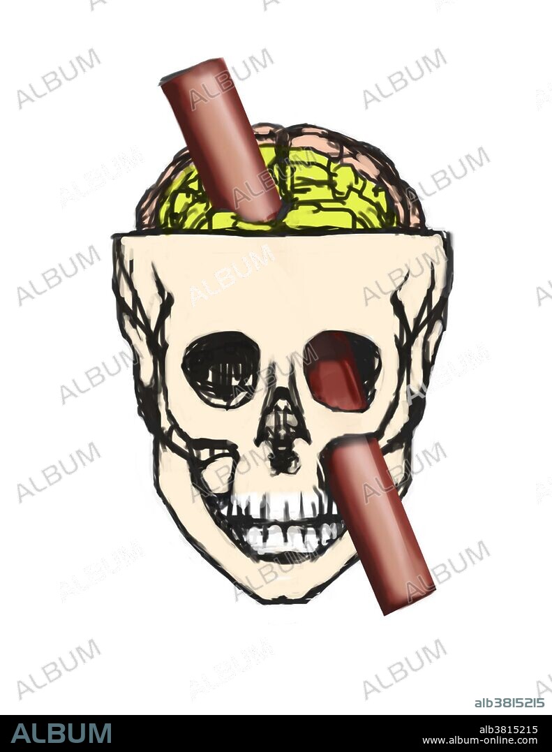 Brain Injury of Phineas Gage, Illustration