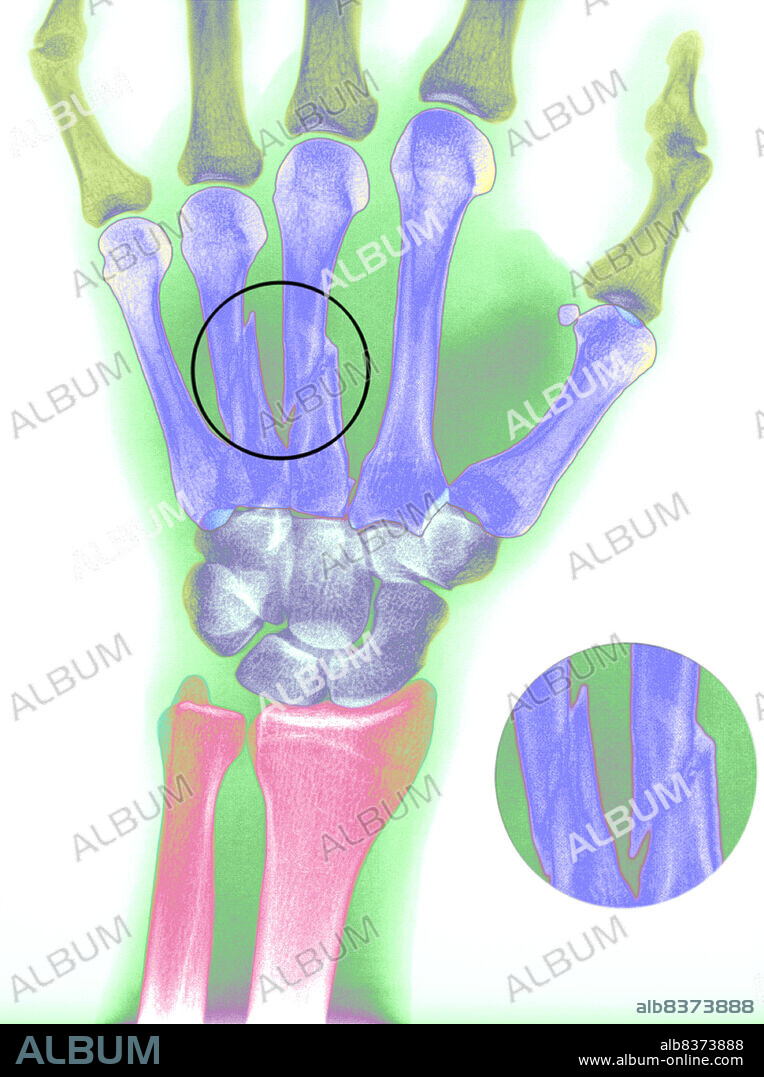 Colorized x-ray of a fracture of the 3rd and 4th metacarpal bones of the left hand of a 24-year-old patient.