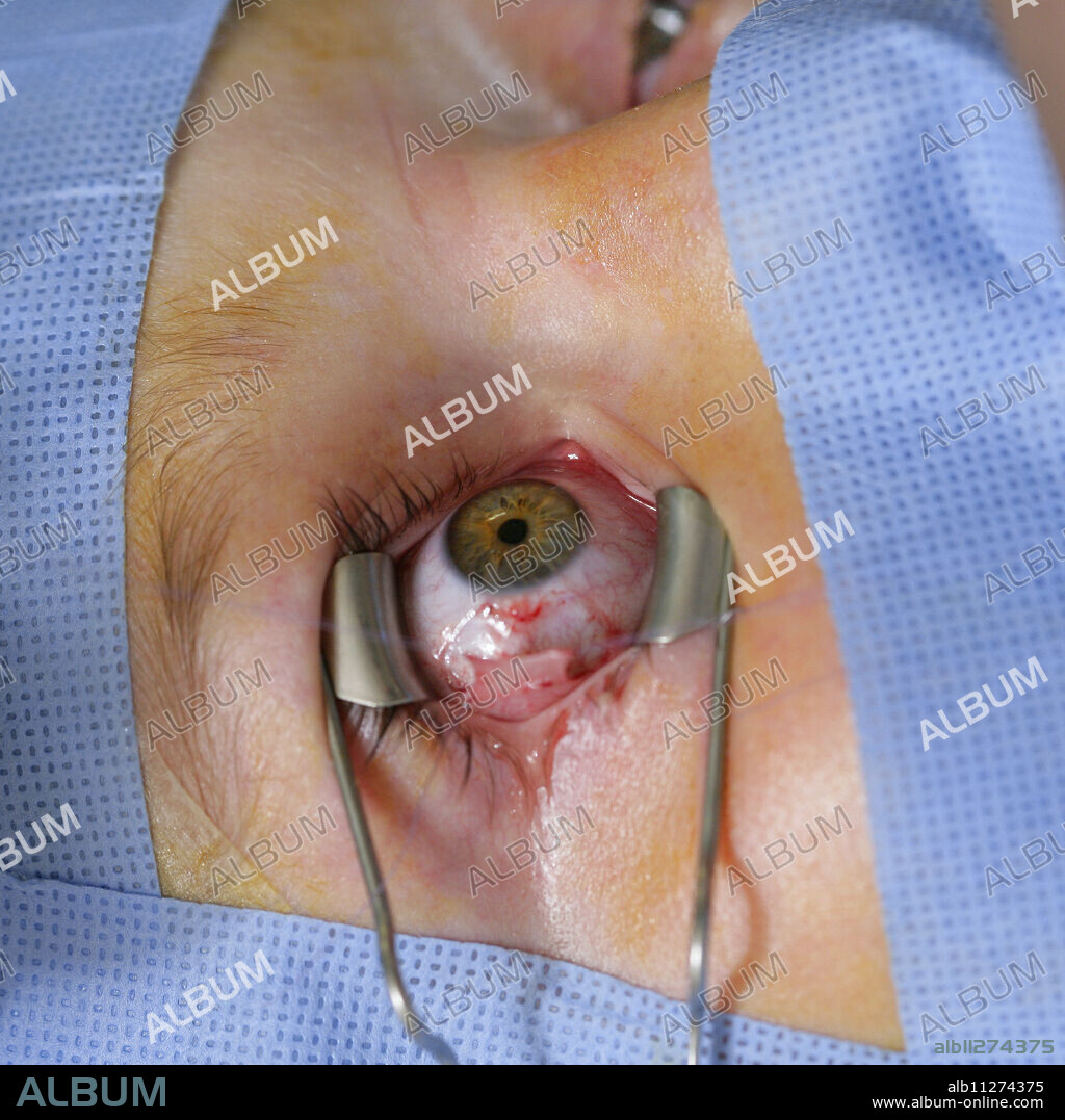 Report from the ophthalmological department of the Rouen University Hospital. Strabismus surgery.