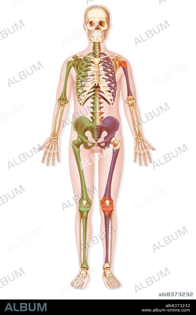 Illustration of bones affected by various types of sarcoma or bone cancer:. -chondrosarcoma in green (shoulder blade, humerus, ribs, the spine, pelvis, femur, tibia). -osteosarcoma in red (upper extremity of the humerus, the lower extremity of the femur , upper extremity of the tibia). -Ewing’s sarcoma in purple (ribs, humeral shaft, pelvis, femoral shaft, tibial shaft).
