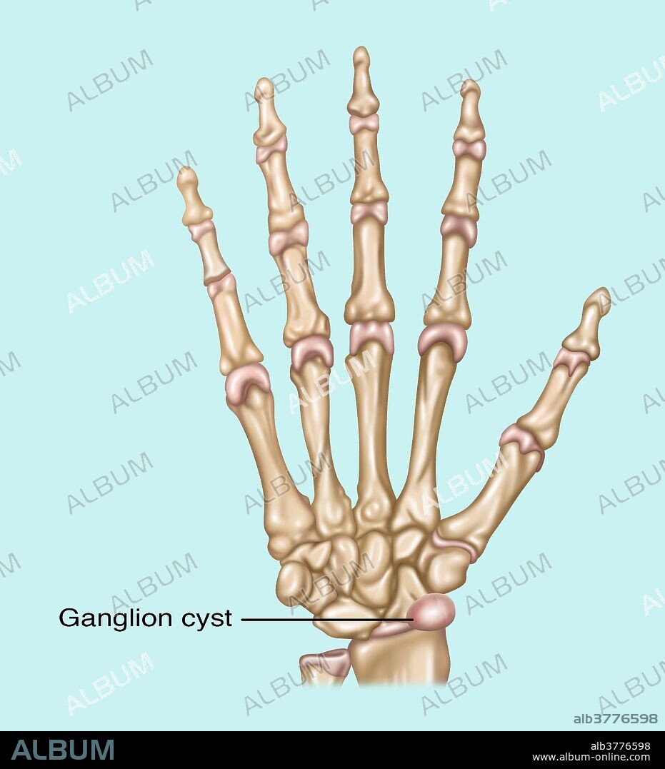 Illustration showing a ganglion cyst (fluid filled sac) in the wrist.