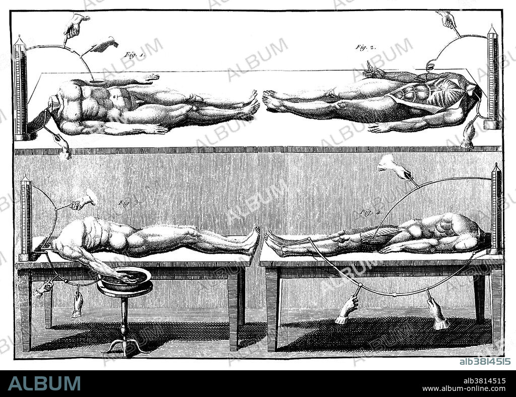 Galvanism experiments. Galvanism is the contraction of a muscle that is stimulated by an electric current. The effect was named after Luigi Galvani (September 9, 1737 - December 4, 1798), who investigated the effect of electricity on dissected animals in the 1780-90s. Giovanni Aldini (April 10, 1762 - January 17, 1834) was an Italian physicist and nephew of Galvani. His most famous public demonstration of the electro-stimulation technique of deceased limbs was performed on the executed criminal George Forster in London, 1803. The Newgate Calendar describes what happened: "On the first application of the process to the face, the jaws of the deceased criminal began to quiver, and the adjoining muscles were horribly contorted, and one eye was actually opened." Image appeared in "Essai theoretique experimental sur le Galvanisme" by Giovanni Aldini, 1804.