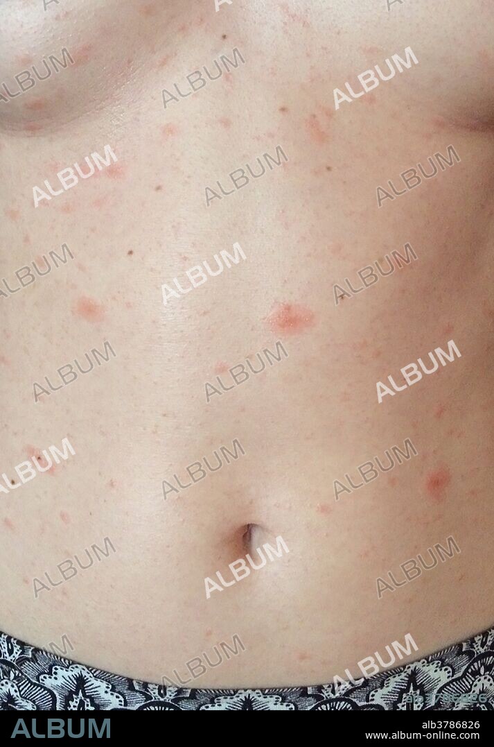 Pityriasis rosea on the chest and stomach.