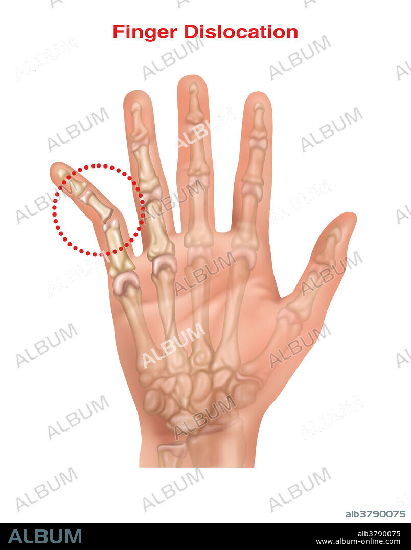 Illustration showing a dislocated little (or 5th) finger.
