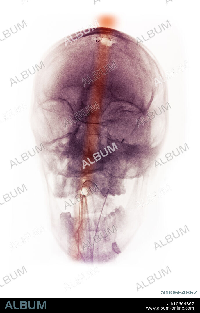A skull x-ray of a 30 year old man who shot himself in the head. The bullet entered below the mandible and emerged through the skull passing through the frontal lobe. Scattered metal fragments are seen overlying the left maxillary and orbital region and at the exit wound at the skull.