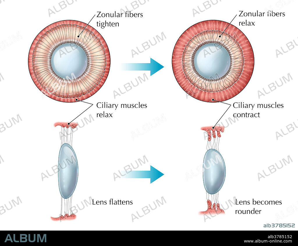An illustration depicting the accommodation of the lens as the eye focuses on near or distant objects. Ciliary muscle contractions, taking place inside the eye, control the shape of the lens. When focusing on a distant object, the muscles relax to increase tension of the suspensory ligaments (zonular fibres) and keep the lens flattened. When focusing on a nearby object, the muscles contract, causing the suspensory ligaments to relax and allow the lens to form a rounder shape and increase its refractive power.
