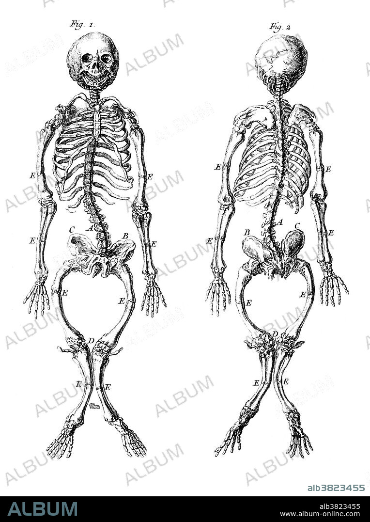 A rachitic skeleton, measuring two feet two inches in length, seen from the front and the back. Rickets is among the most frequent childhood diseases in many developing countries. The predominant cause is a vitamin D deficiency, but lack of adequate calcium in the diet may also lead to rickets. A sufficient amount of ultraviolet B light in sunlight each day and adequate supplies of calcium and phosphorus in the diet can prevent rickets. Darker-skinned people need to be exposed longer to the ultraviolet rays. The replacement of vitamin D has been proven to correct rickets using these methods of ultraviolet light therapy and medicine. Engraving, 1749.
