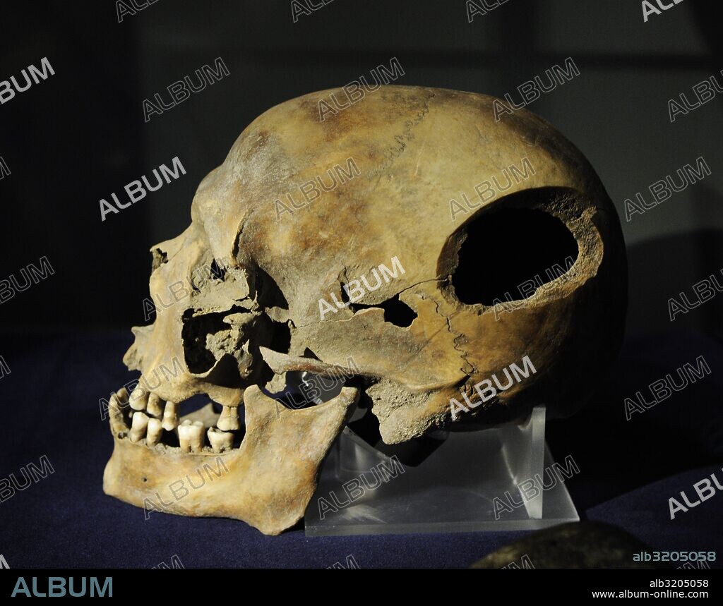 Edad Media. Cráneo con la marca de una herida mortal. Museo Histórico (Swedish History Museum). Estocolmo. Suecia.
