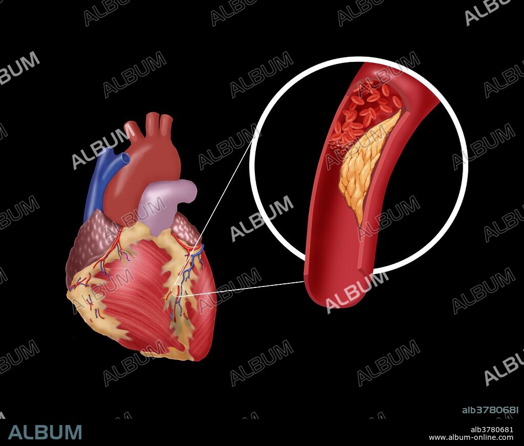 Illustration showing the coronary artery with thrombosis (blood clot) resulting from advanced atherosclerosis.