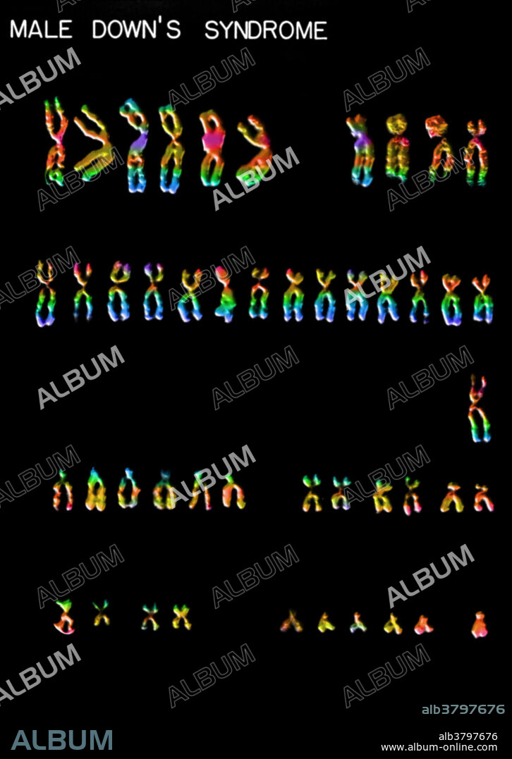 Colour enhanced micrograph of a karyotype for a human male with Down's Syndrome. It is characterized by an extra copy of genetic material on the 21st chromosome. Karyotypes are an arrangement of chromosomes based on their appearance under a light microscope.