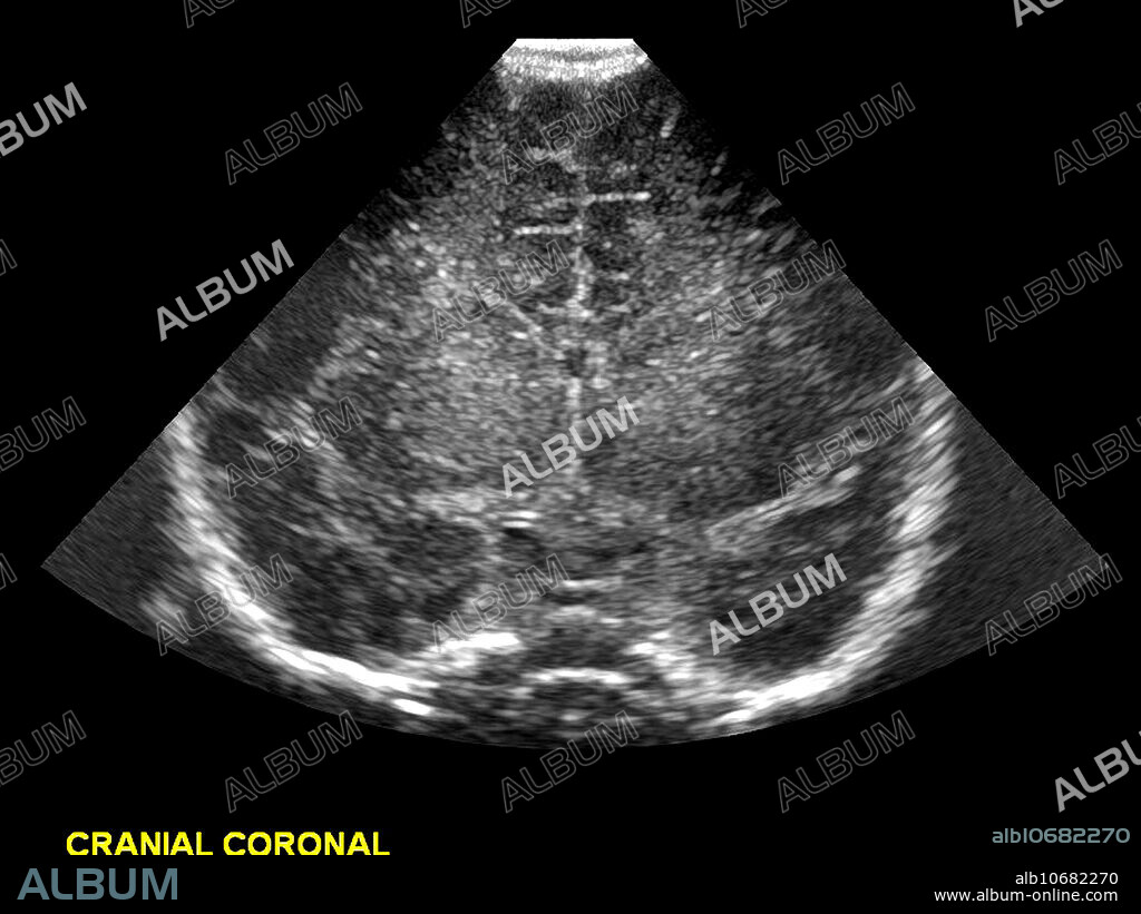 This coronal (from the front) ultrasound image obtained through the anterior fontanella shows the normal appearance of the frontal and temporal lobes. The ventricles are not enlarged (no hydrocephalus). The gaps present within the fetal skull (fontanelles) are used as acoustic windows to view the intracranial structures. Ultrasound is commonly and frequently used to image the newborn and young infant because of its ease (machine can be transported to the neonatal ICA easily) and there is no ionizing radiation.