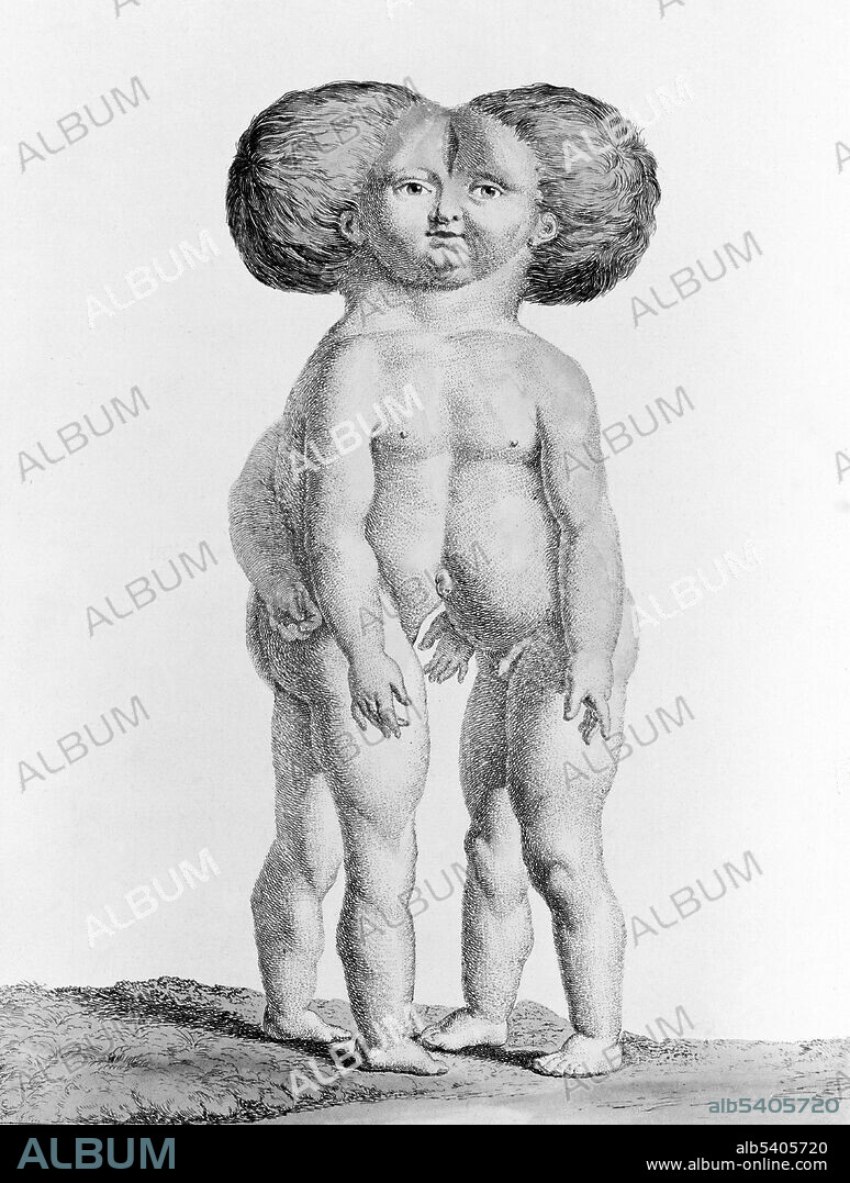 Conjoined twins, from 1775. Engraved by Nicolas-Francois Regnault and entitled "Double Child.".