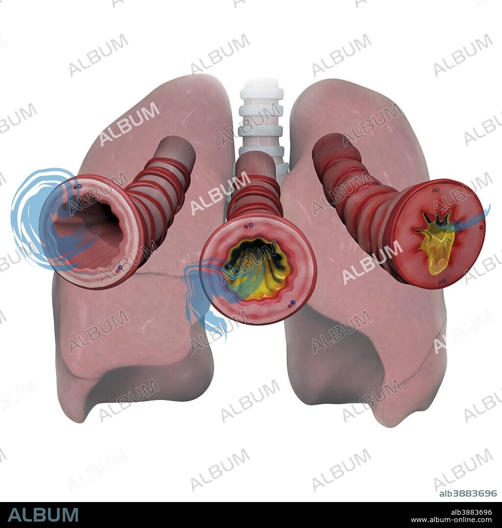 3D model of lungs and bronchioles depicting asthma airflow in various stages with inflammation and mucus.