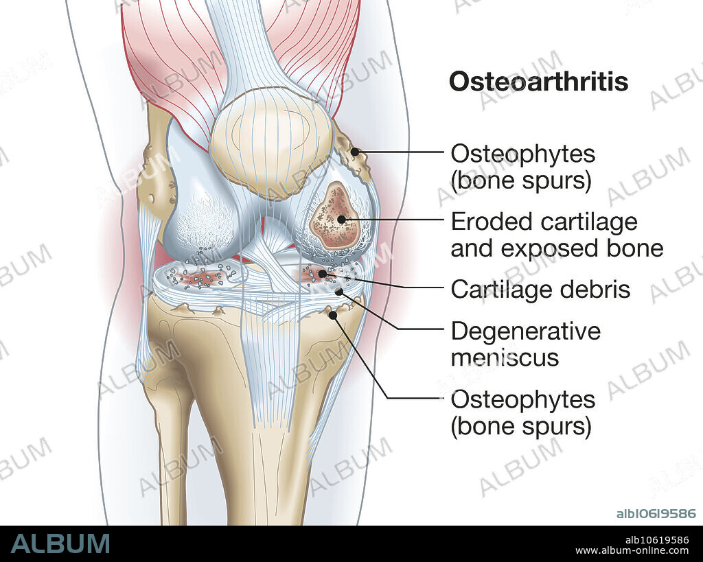 Illustration showing knee joint osteophytes, erodet cartilage, exposed bone and degenerative menisci.