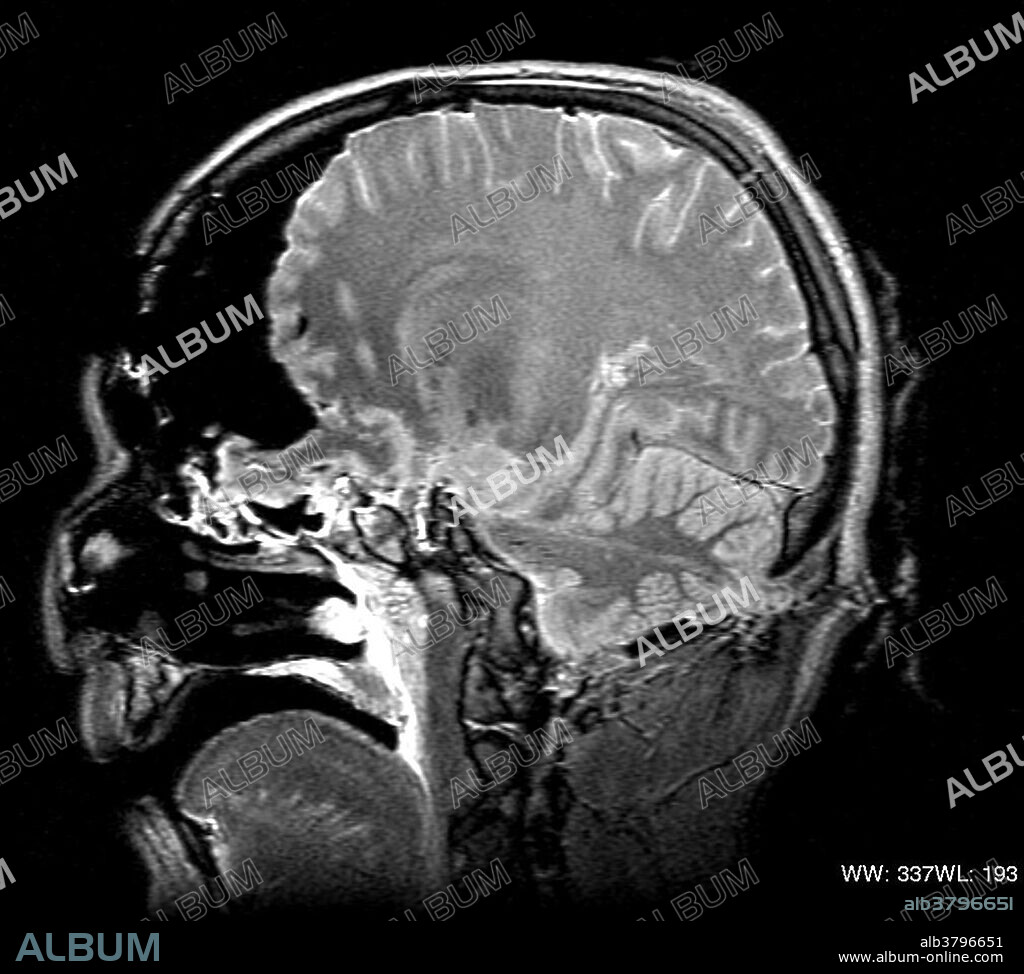 This MRI cross section shows the wound track through the brain stem and the cerebellum. 2003. MRI, also called NMR, magnetic resonance imaging: a noninvasive diagnostic procedure employing an MR scanner to obtain detailed sectional images of the internal structure of the body.