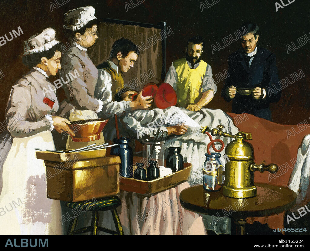 MORTON GREEN, William Thomas (1819-1868). American dentist, who first successfully used ether as an anesthetic in surgery. Representation of an intervention at Bellevue Hospital in New York in 1870. The patient was operated without disinfection and ether anesthesia, experienced for the first time on 16 October 1846.