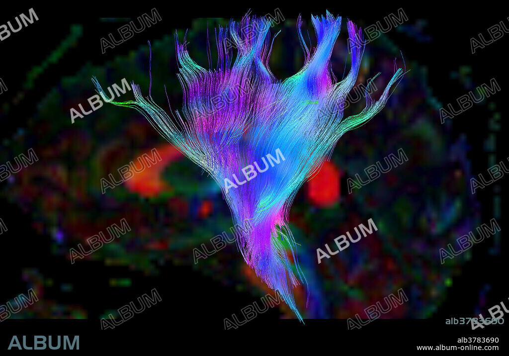 This colour image demonstrates the normal appearance of the white matter fibre tracts making up the coronal radiata, spiralling down into the pontine region of the brainstem. By convention the colour is coded so that blue indicates fibre tract direction in the superior (top) to inferior (bottom) direction, red indicates right to left (horizontal) fibre tract orientation and green indicates fibre tract directionality from anterior (front) to posterior (back).