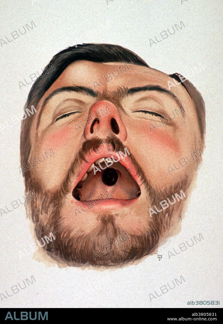 Syphilis is a sexually transmitted infection caused by the bacterium Treponema pallidum subspecies pallidum. The signs and symptoms of syphilis vary depending in which of the four stages it presents (primary, secondary, latent, and tertiary). Tertiary syphilis may occur approximately 3 to 15 years after the initial infection, and may be divided into three different forms: gummatous syphilis, late neurosyphilis, and cardiovascular syphilis. Gummatous syphilis or late benign syphilis usually occurs 1 to 46 years after the initial infection, with an average of 15 years. This stage is characterized by the formation of chronic gummas, which are soft, tumor-like balls of inflammation which may vary considerably in size. They typically affect the skin, bone, and liver, but can occur anywhere. Chromolithograph appeared in "Bramwell, Byrom Atlas of Clinical Medicine", 1893.