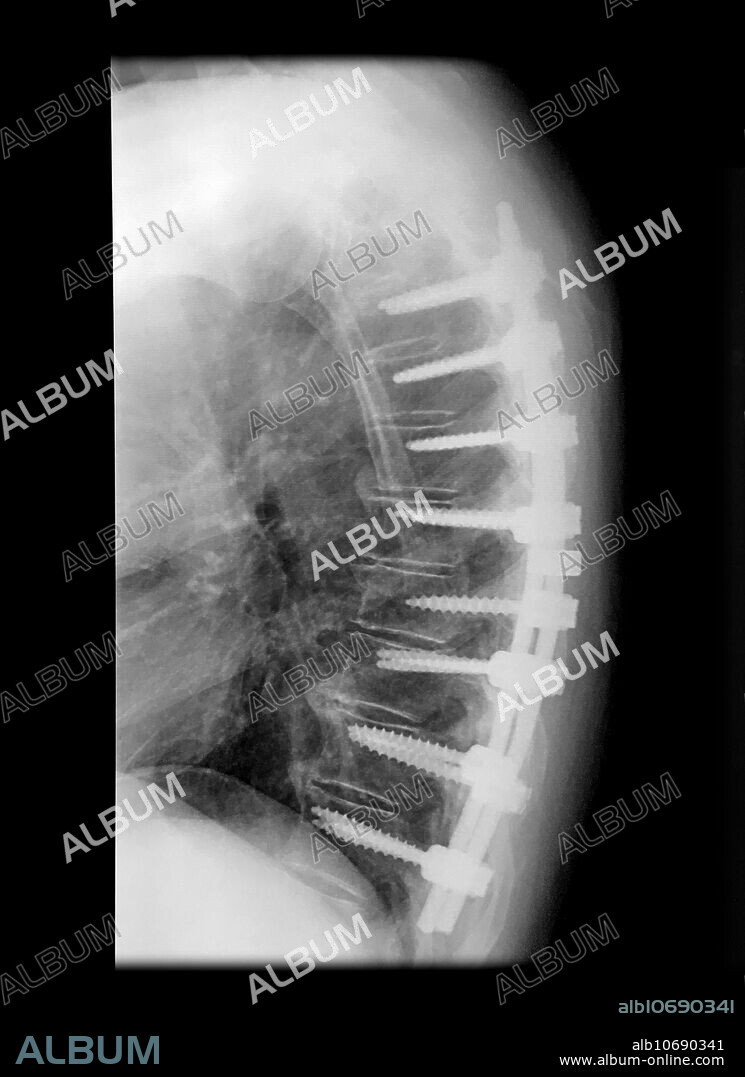 This lateral (from the side) x-ray of the chest/thoracic spine shows extensive post surgical changes in the thoracic spine with multiple pedicle screws and vertical stabilization rods.