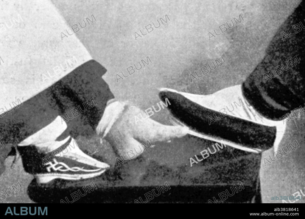 Bound Compared to Normal Foot, China, 1899