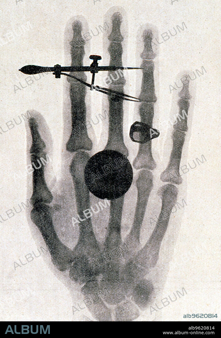 WILHELM CONRAD RONTGEN. Wilhelm Roentgen's X-ray photograph of his wife's hand, 1896. For his work on electromagnetic radiation and the discovery of X-rays, Roentgen (1845-1923) was awarded the 1901 Nobel prize for Physics.