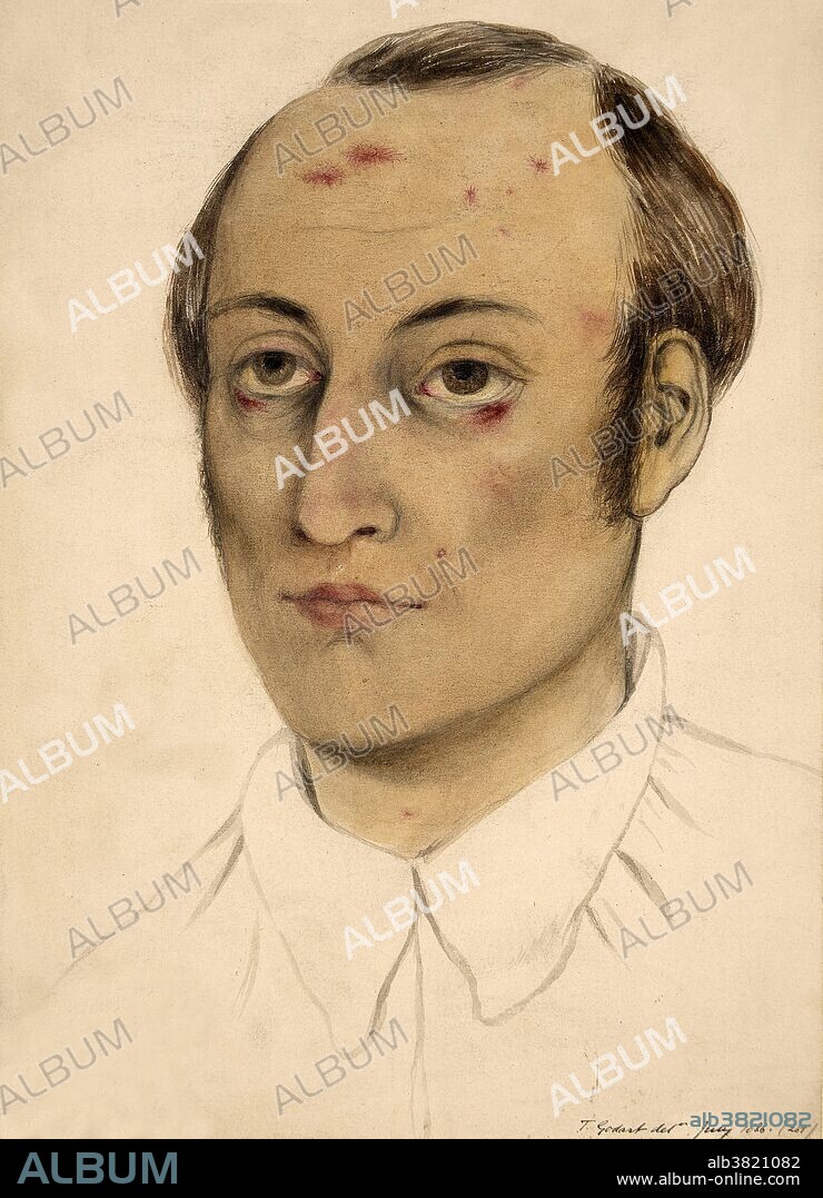 Cirrhosis of Liver, Male Patient, 1886