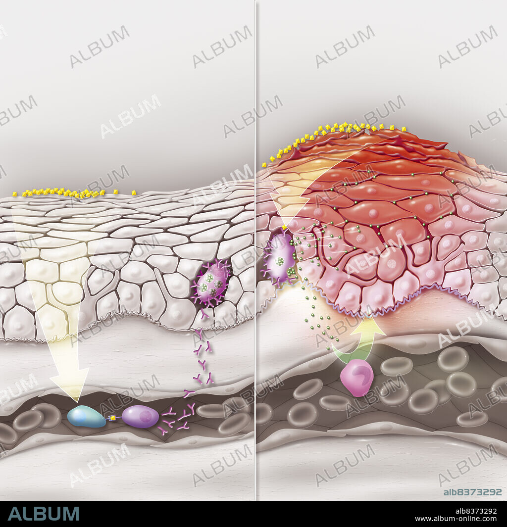 Représentation de l'allergie de contact cutanée, au premier contact, phase de sensibilisation et au deuxième contact, déclenchant la réaction allergique. Lors du premier contact avec des allergènes, les cellules dendritiques capturent les allergènes puis migrent vers les ganglions lymphatiques (phase simplifiée par la flèche jaune). Réponse immunitaire des lymphocytes T ou B (cellule bleue et violette) avec production d’anticorps IgE qui reconnaissent l’allergène. Fixation des IgE sur les mastocytes (cellule rose dans l'épiderme). Après la phase de sensibilisation, tout contact avec l’allergène déclenche une réaction allergique. L’allergène entre en contact avec les mastocytes qui le reconnaissent. Celui-ci libère des substances inflammatoires (vertes) comme l’histamine, responsable d'oedème et de démangeaisons de la peau.
