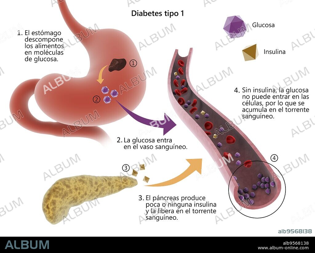 Medical diagram of Type 1 diabetes.