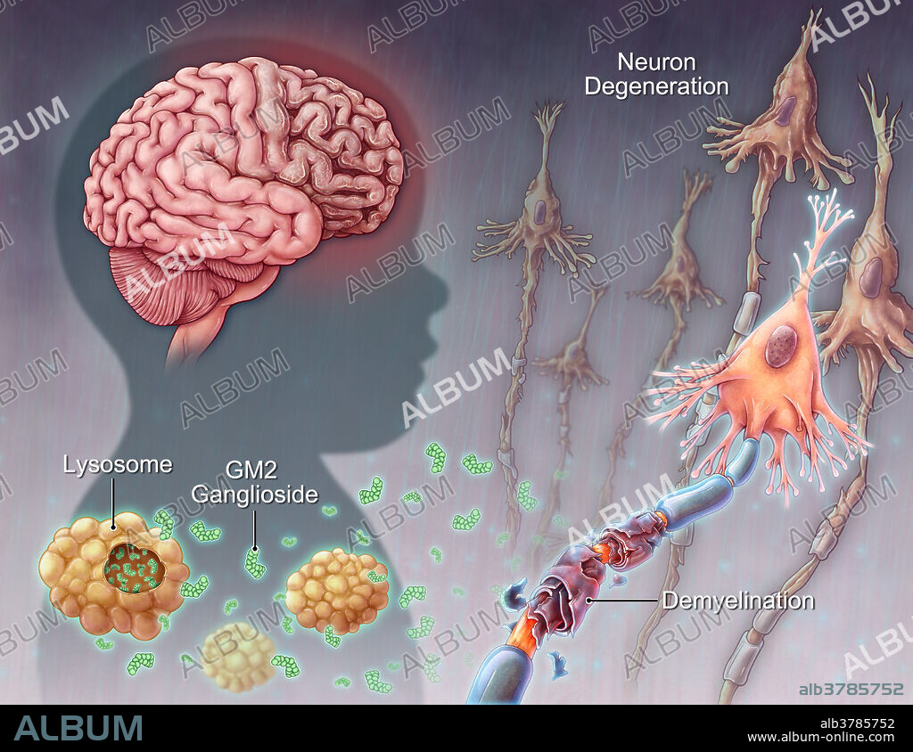 Tay-sachs Disease, illustration