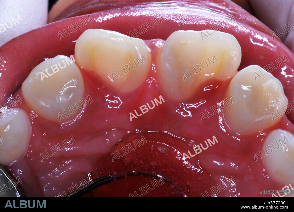 Dens in Dente Malformation Repair