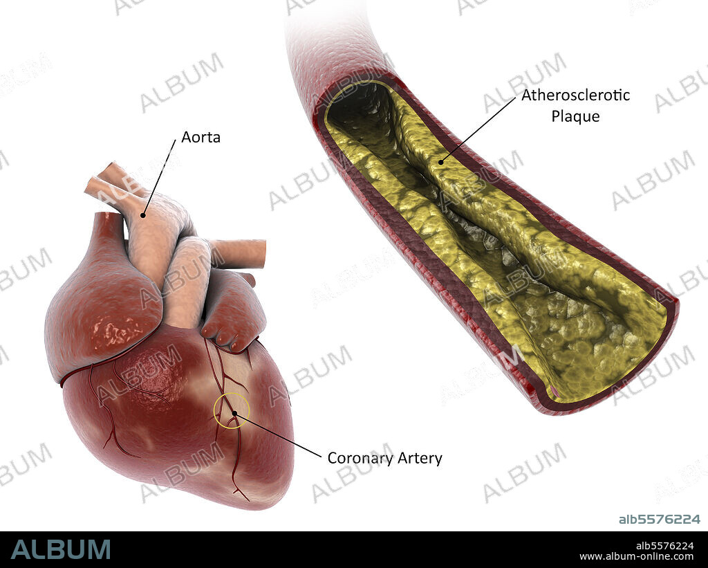 Medical illustration of atherosclerotic plaque in the artery, leading to a heart attack.