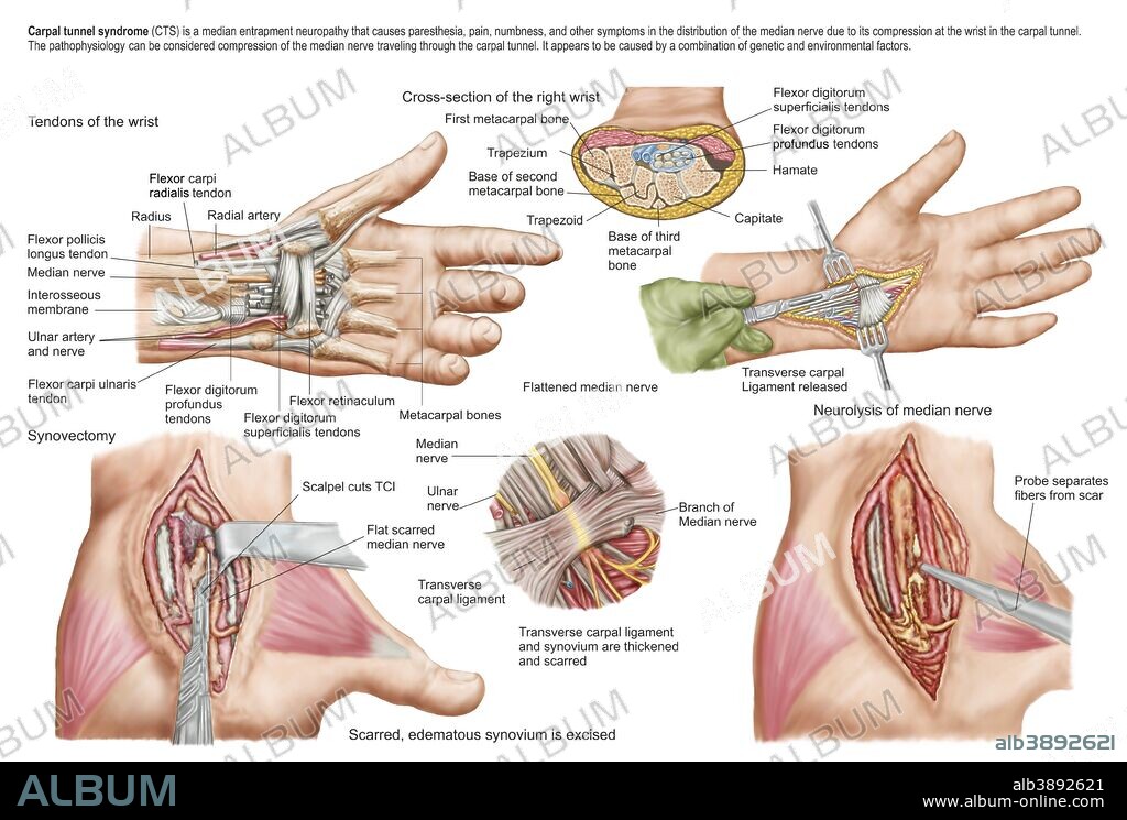 Medical illustration showing carpal tunnel syndrome in the human wrist, and the surgical procedures associated with it.