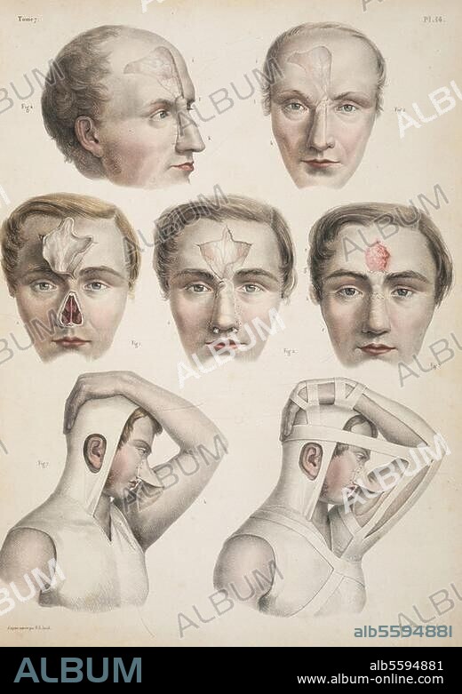 Medicine / Plastic Surgery. "Rhinoplastique". (Artificial nose created from the skin of the forehead and the upper arm). Col. lithograph after drawing by Nicolas Henri Jacob (1782-1871). From: M.J. Bourgery, Traité complet de l'anatomie de l'homme, 1831-54, vol. 7, pl. 14. Private Collection.