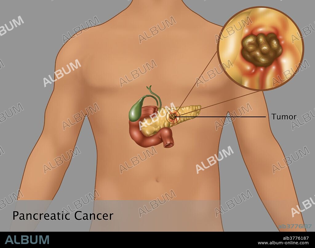 Pancreatic Cancer in Male Figure, Illustration - Album alb3776187 Pancreatic Cancer in Male Figure, Illustration - Album alb3776187